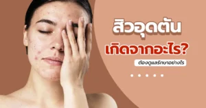 สิวอุดตัน เกิดจากอะไร ดูแลอย่างไรให้หาย