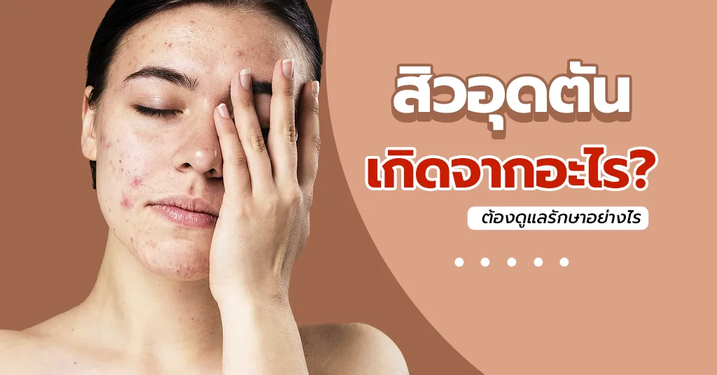 สิวอุดตัน เกิดจากอะไร ดูแลอย่างไรให้หาย