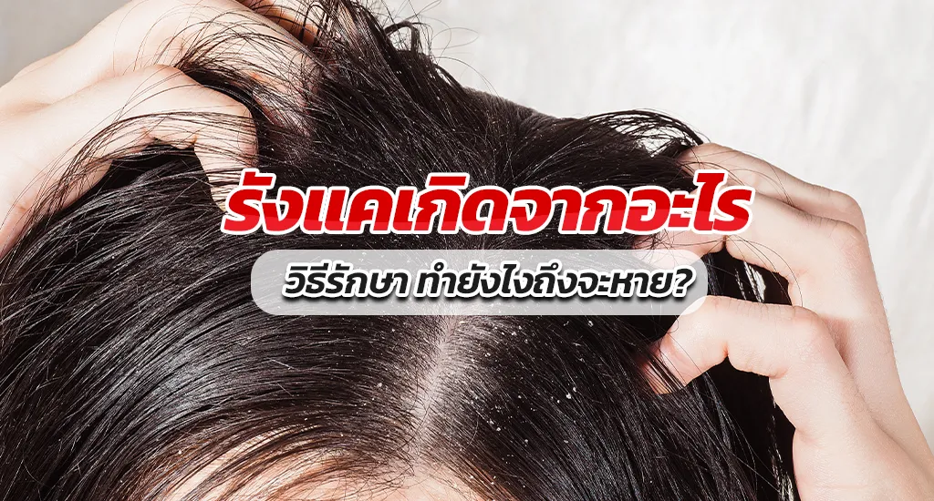 รังแคเกิดจากอะไร วิธีรักษา ทํายังไงถึงจะหาย