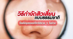 วิธีกำจัดสิวเสี้ยนแบบธรรมชาติ-โดยใช้อุปกรณ์ที่หาได้ง่ายๆ-ในบ้าน