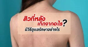 สิวที่หลังเกิดจากอะไร มีวิธีดูแลรักษาอย่างไร ทำยังไงถึงหาย