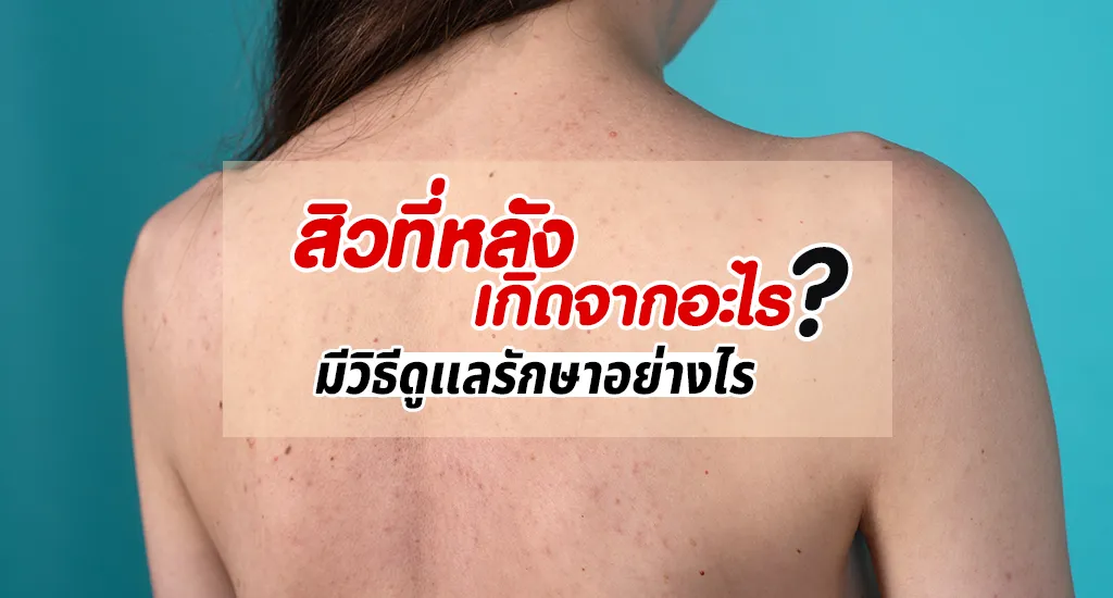 สิวที่หลังเกิดจากอะไร มีวิธีดูแลรักษาอย่างไร ทำยังไงถึงหาย