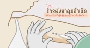 การฝังยาคุม